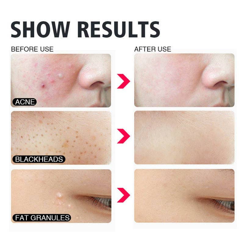 1 Pack (Misture & Match Padrões) Agulhas de remoção de pretos de qualidade Premium 4 pcs Acne para venda a revendedores na Faire6