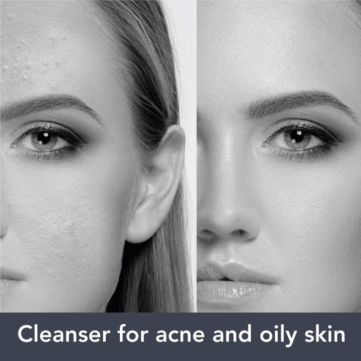 Q1 - Wholesale Facial Cleanser - Q-Acne Detersion - Oily Skin Cleanser that Removes Sebum and2
