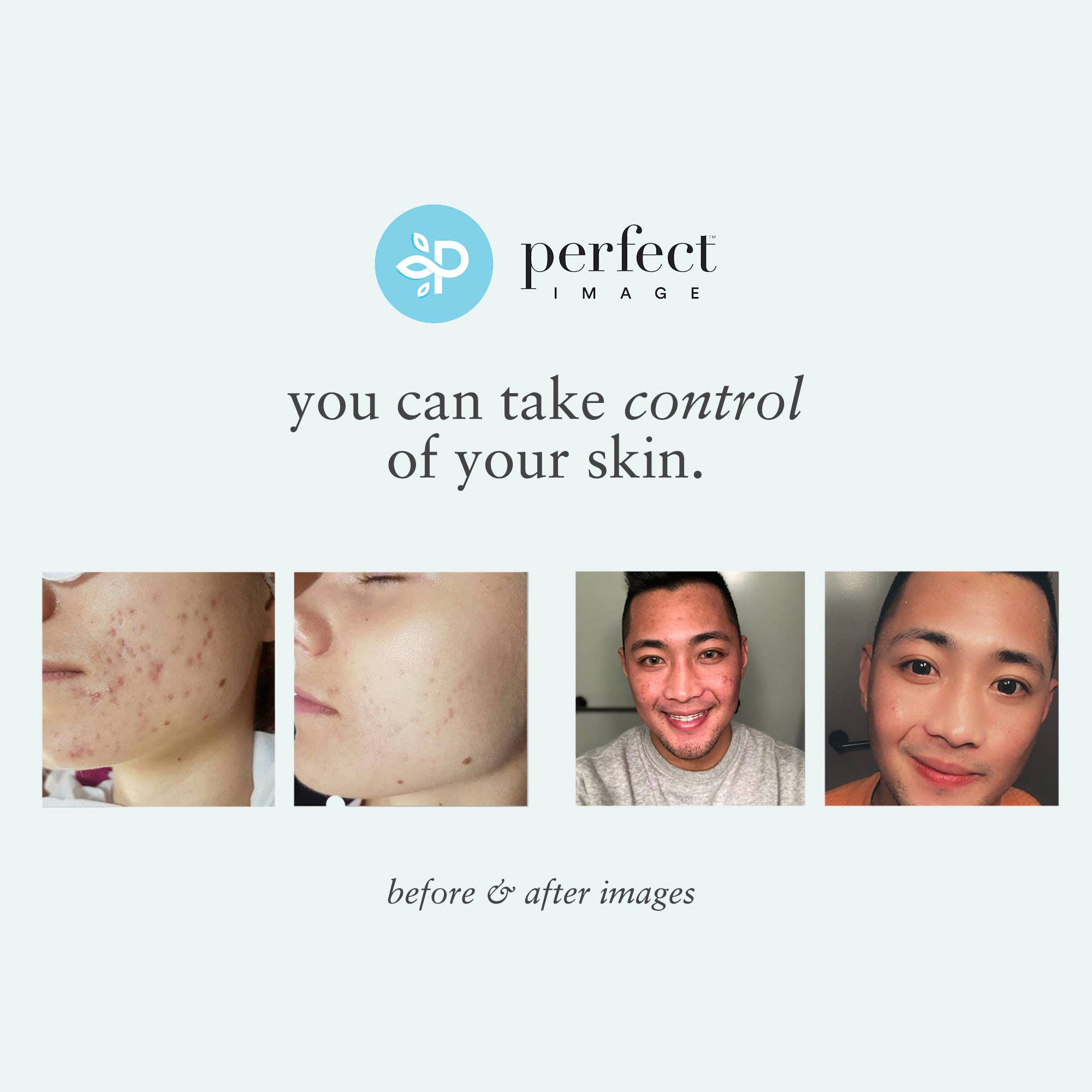 Perfect Image - Wholesale Facial Peel - Lactic 30% Gel Peel - Level 18