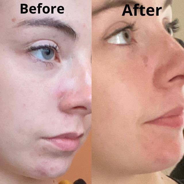 Douvall's - Vente Concentré/sérum pour le visage - Sérum de réadaptation contre l'acné 30 ml8