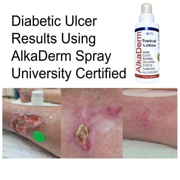AlkaVita - Wholesale Acne/hydrocolloid patch - Skin Disorders Remedy AlkaDerm Spray University Certified 1