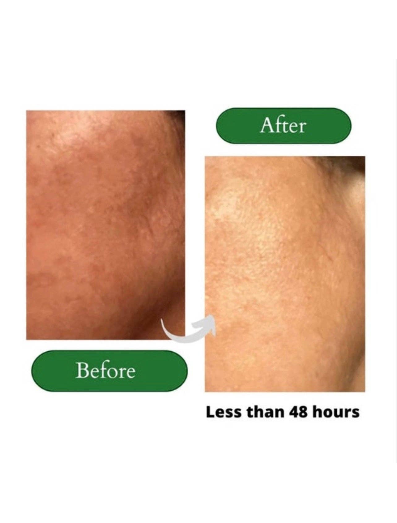 LOHV ESSENTIALS - Wholesale Facial Care Set/Kit - 4 Steps Solution to Clear, Healthy, Youthful Skin PREMIUM 100% VEGAN SKINCARE  SYSTEM+ Hyaluronic Acid + Retinol + Lactic Acid + Glycolic Acid + Niacinamide + SPF 307