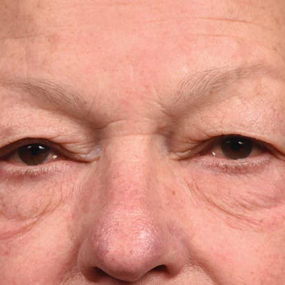 SilcSkin - Vendita all'ingrosso Maschere trattamento occhi - Cuscinetti per occhi SilcSkin3