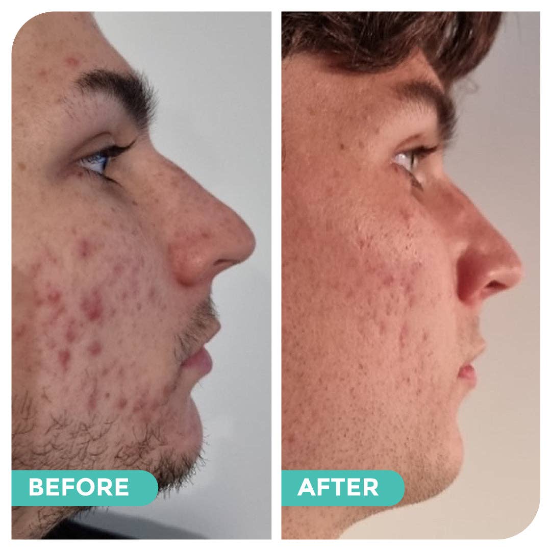 Hemp Co Australia - Wholesale Facial Care Set/Kit - Acne skincare bundle5