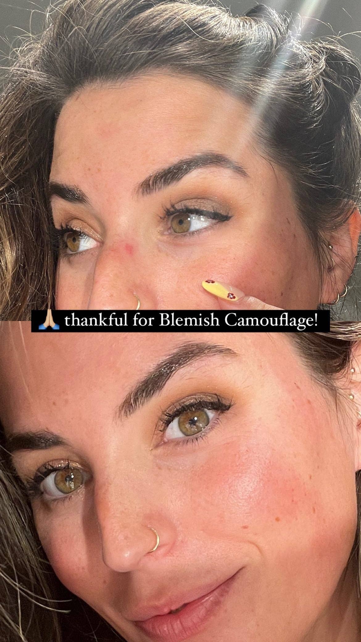 August & Monroe, Inc - Wholesale Acne/Hydrocolloid Patch - 3-IN-1 BLEMISH CAMOUFLAGE5