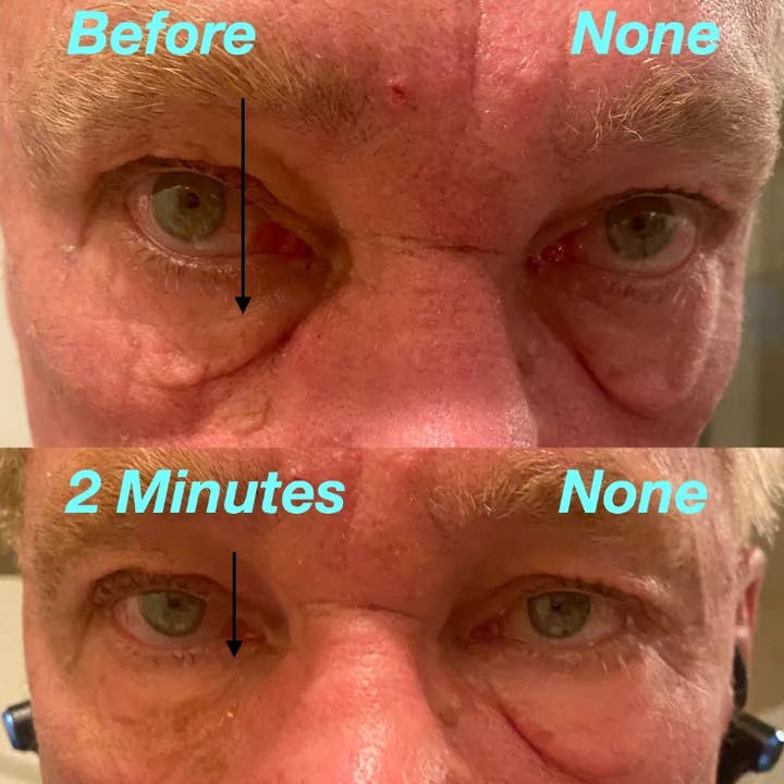 Spa Vision Medical - Wholesale Eye cream/gel - Better Than Botox Eye Serum - 30 Days Transformation1