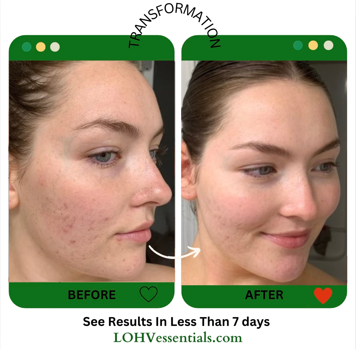 LOHV ESSENTIALS - Wholesale Facial Care Set/Kit - 4 Steps Solution to Clear, Healthy, Youthful Skin PREMIUM 100% VEGAN SKINCARE  SYSTEM+ Hyaluronic Acid + Retinol + Lactic Acid + Glycolic Acid + Niacinamide + SPF 305