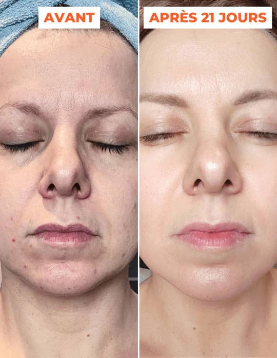 DERMEDEN - Vente Masque exfoliant pour le visage - Peeling avancé en 2 étapes inspiré de techniques dermatologiques2