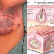 Nancy Natural Beauty Skincare – Großhandel Heilsalbe/Balsam/Creme – Hidradenitis Suppurativa Entlastungscreme5