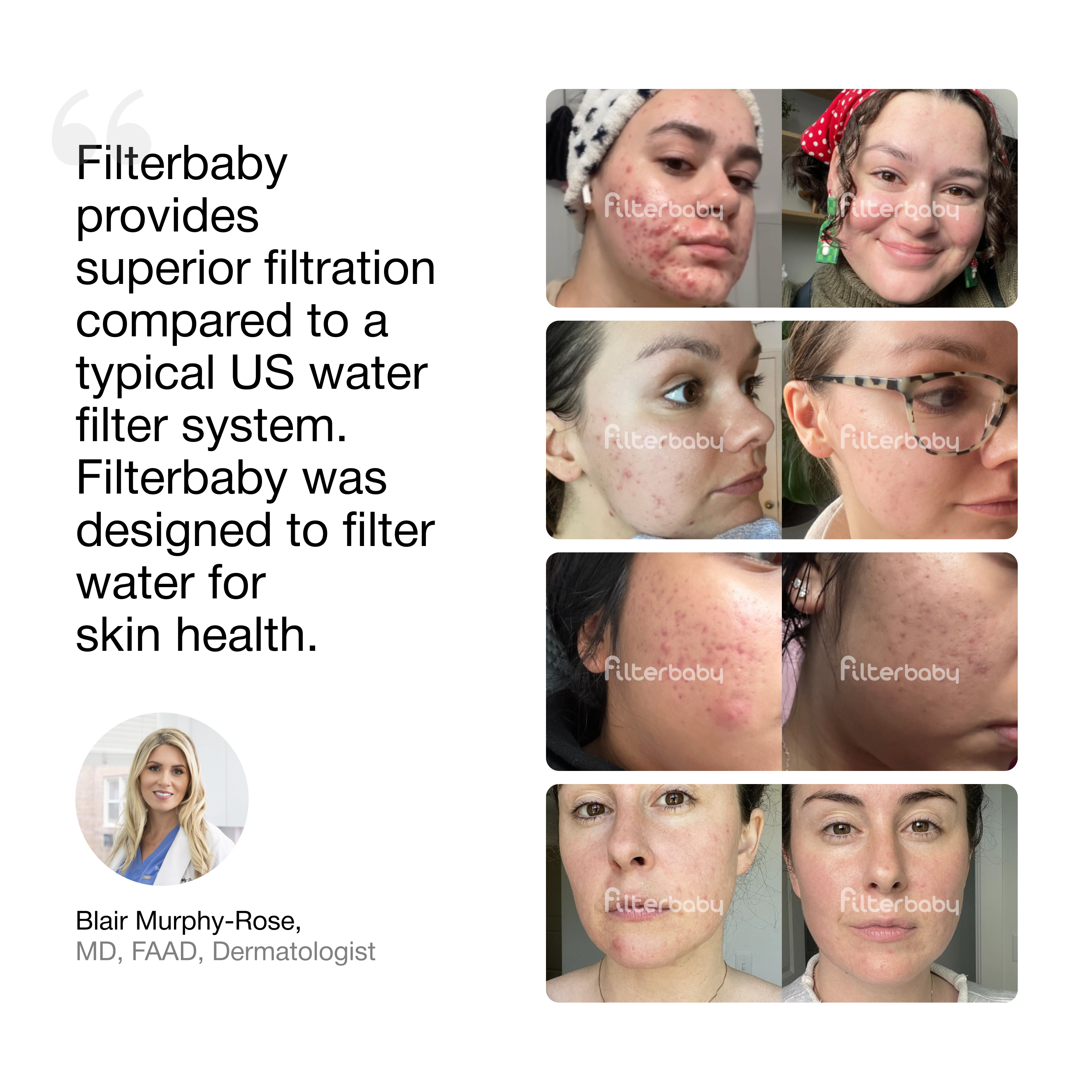 Filterbaby - Vendita all'ingrosso Rulli viso/di bellezza - Filtro per Acqua da Rubinetto per Cura della Pelle Filterbaby 1.06