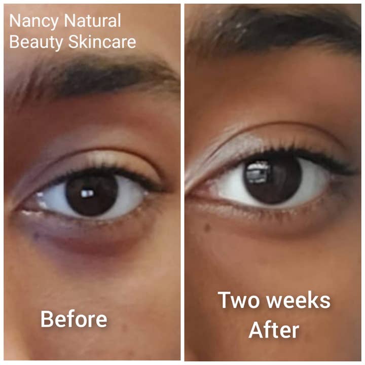 Nancy Natural Beauty Skincare - Wholesale Gezichtsolie - Natuurlijke acne en hyperpigmentatieolie (Tamanu + Acai-olie)1