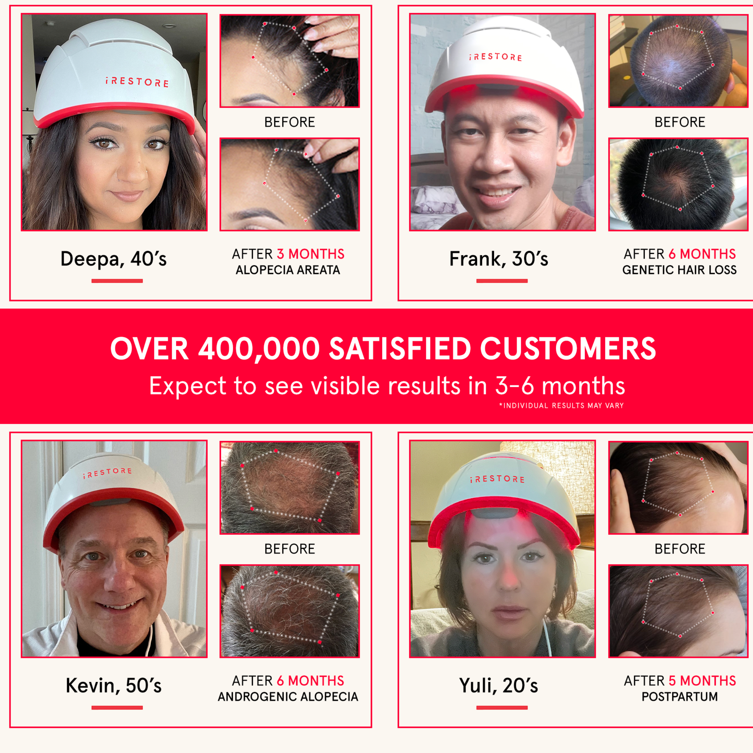 iRESTORE - Wholesale Scalp/Hair Treatment - iRESTORE PRO Laser Red Light Therapy Hair Growth6