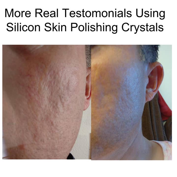 AlkaVita - Wholesale Hydrocolloïde acnepleister - Acne Huidlittekens SILICON Polishing Crystals Gel Ingesprongen huid