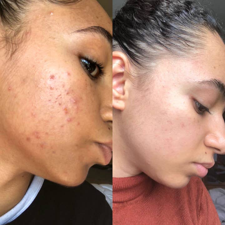 Douvall's - Vente Concentré/sérum pour le visage - Sérum de réadaptation contre l'acné 30 ml3