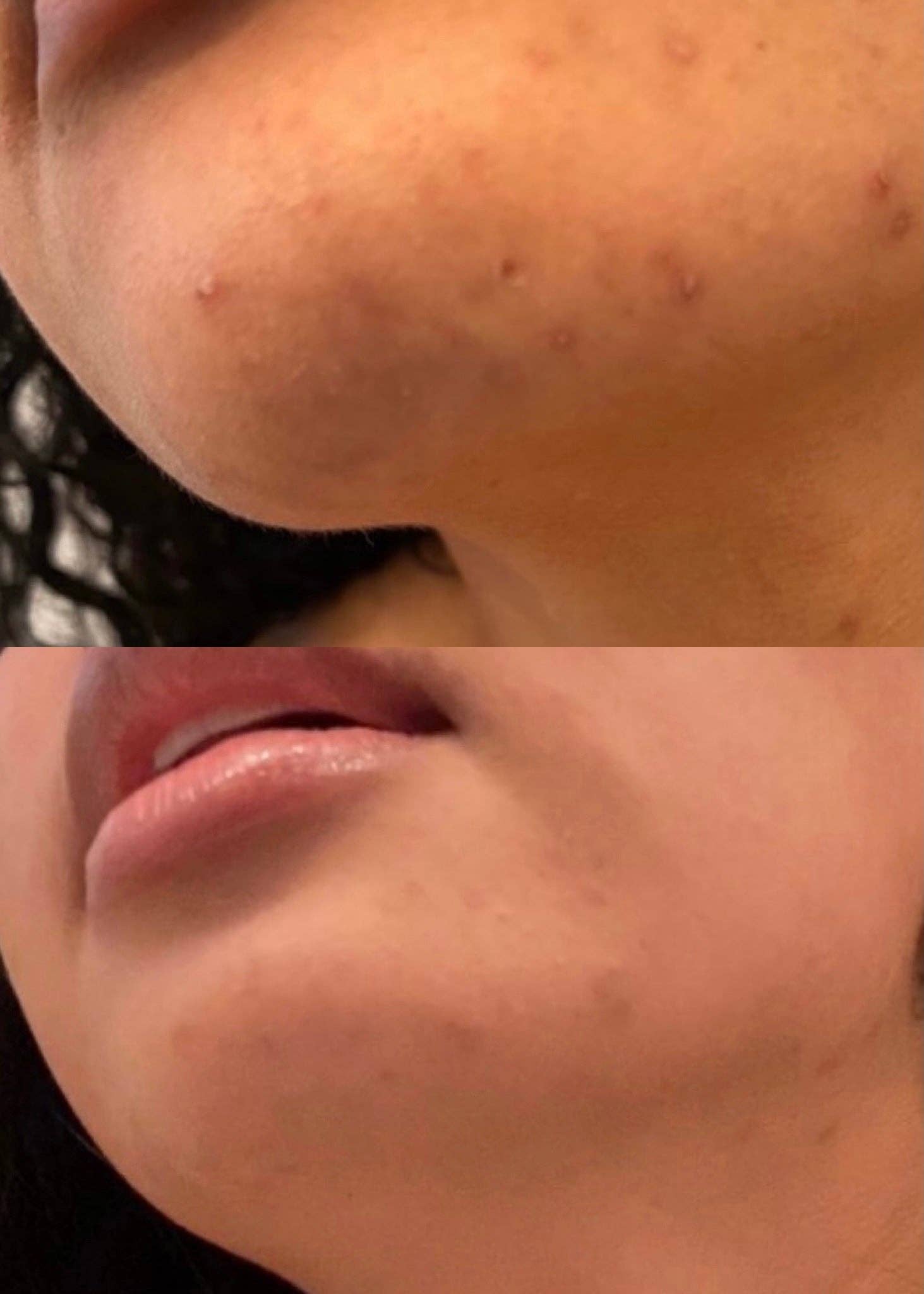 August & Monroe, Inc - Wholesale Acne/Hydrocolloid Patch - 3-IN-1 BLEMISH CAMOUFLAGE8