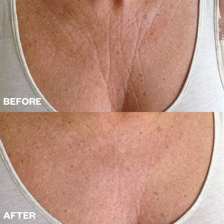 Wrinkles Schminkles - Wholesale Acne/Hydrocolloid Patch - Chest Wrinkle Patch2