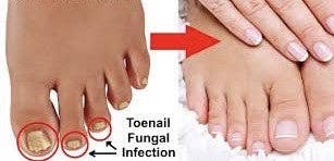 Naturally My Sister’s Keeper - Wholesale Foot Cream - Advanced Fungal Treatment for Feet and Nails4